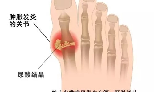 肛门溃疡-肛门溃疡怎么用药网—知名的肛门溃疡怎么回事网站,分享肛门溃疡用什么药治愈最快最有效知识